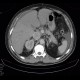 Renal carcinoma, tumorous thrombosis of inferior vena cava, pericardial metastasis: CT - Computed tomography